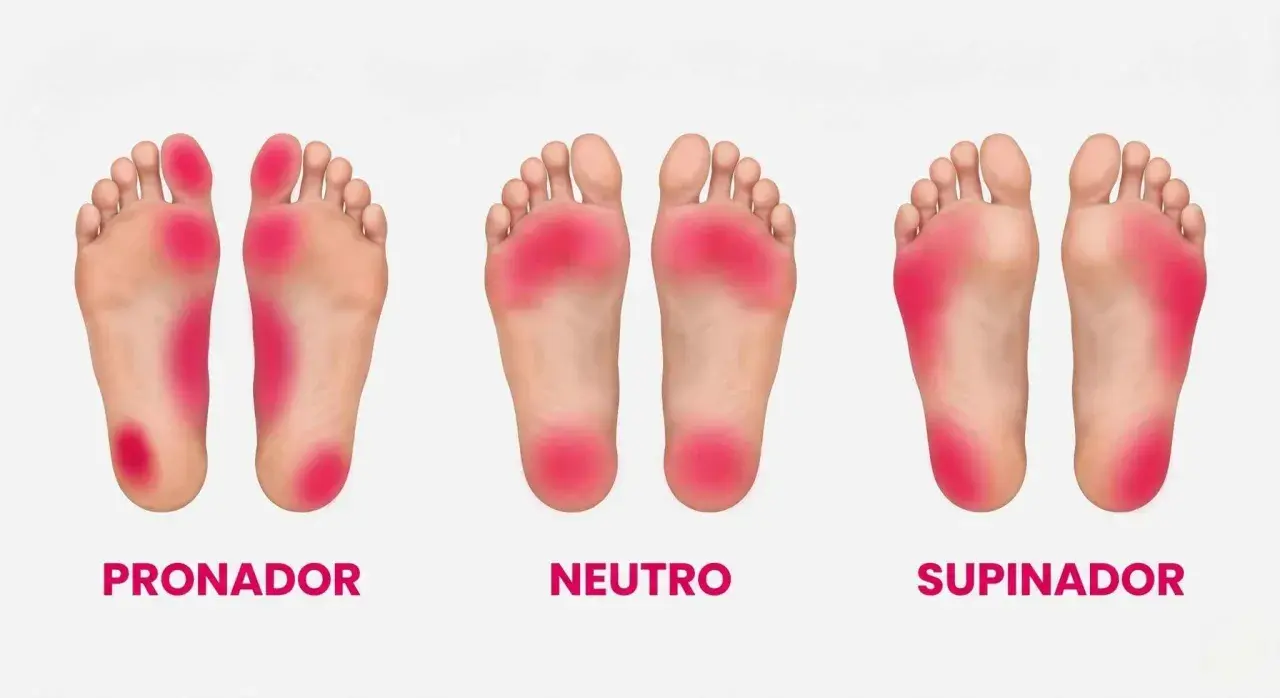 Plantillas de pies: pronador, neutro y supinador. El pie supinador muestra presión en el borde exterior.