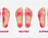 Plantillas de pies: pronador, neutro y supinador. El pie supinador muestra presión en el borde exterior.