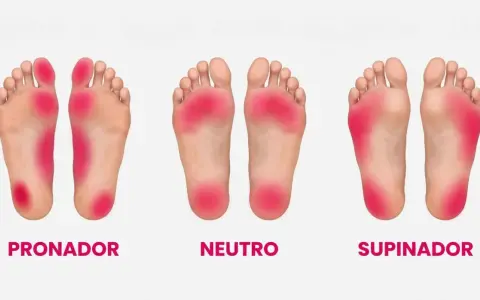 Plantillas de pies: pronador, neutro y supinador. El pie supinador muestra presión en el borde exterior.
