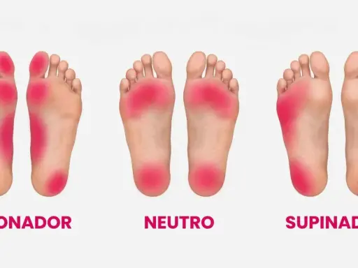 Plantillas de pies: pronador, neutro y supinador. El pie supinador muestra presión en el borde exterior.
