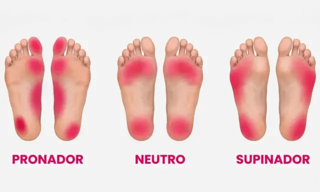 Plantillas de pies: pronador, neutro y supinador. El pie supinador muestra presión en el borde exterior.