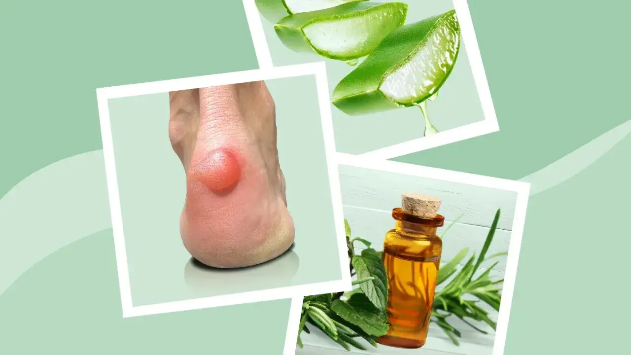 Ampolla en el tal&oacute;n, con aloe vera y aceite esencial para aliviar el dolor.