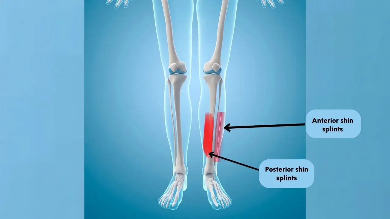 Ilustraci&oacute;n de la anatom&iacute;a de la espinilla, mostrando la zona de dolor espinilla al correr.