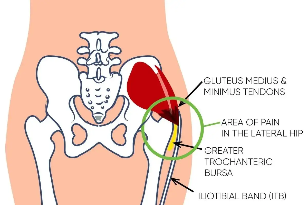 Ilustración de anatomía de cadera que muestra el dolor lateral, tendones del glúteo medio y mínimo, bursa trocantérica y banda iliotibial. Común en el dolor cadera correr.
